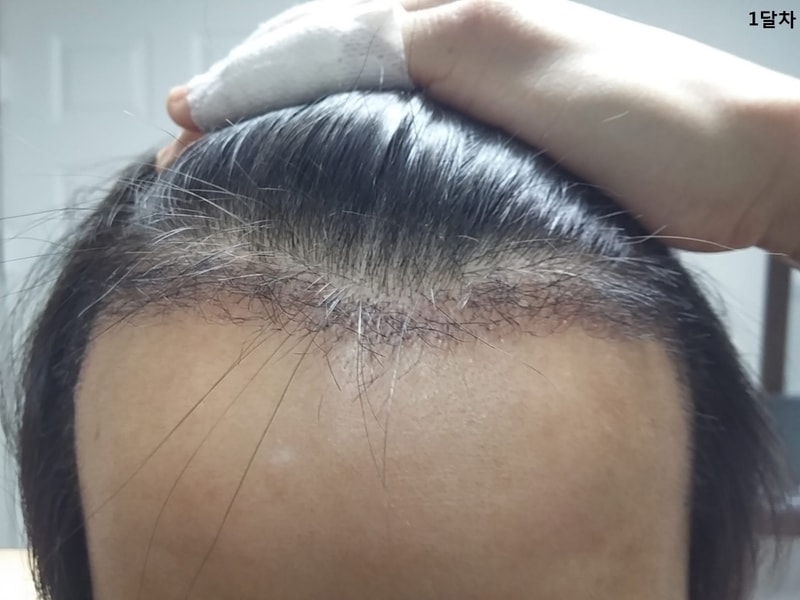 Motion non-cut 1400 hair follicles for 7 months.