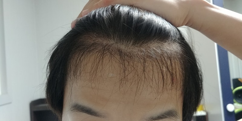 Motion 1400 Follicle 4 Months Evaluation