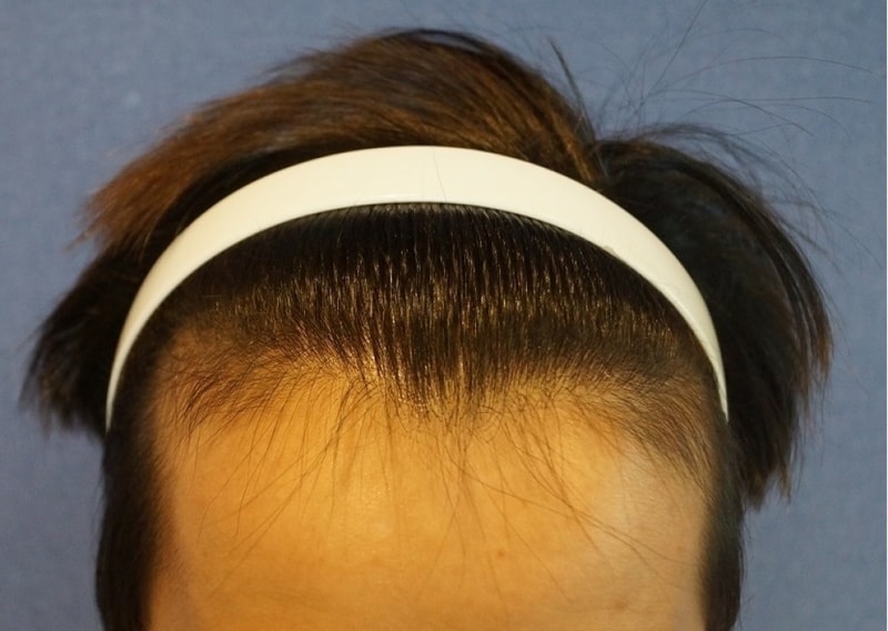 I had 1400 hair follicle surgery today.