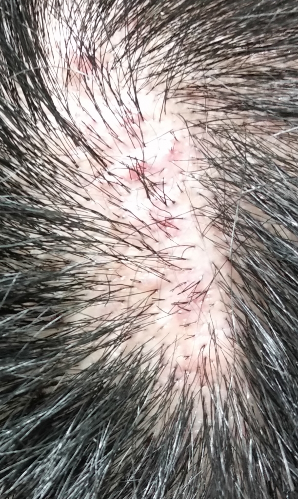 Back scar.jpg
