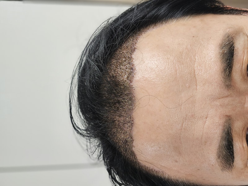 수술후5일차.jpg