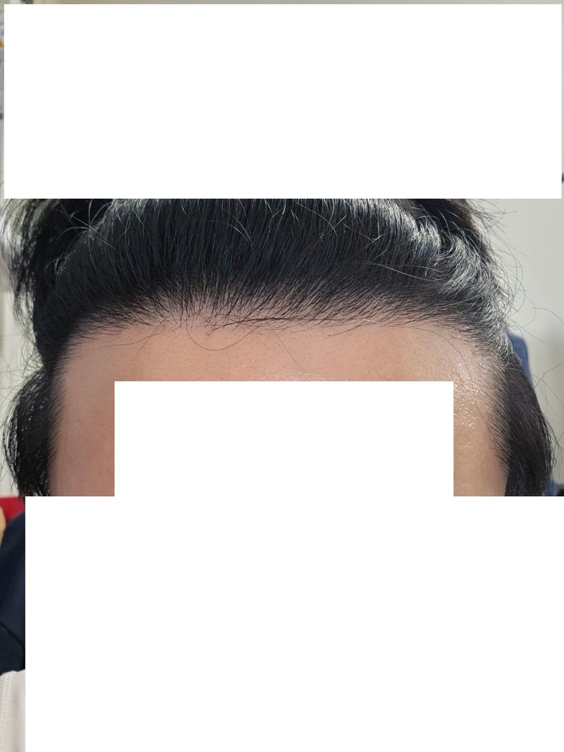 [모재성] 비절개 1100모 12개월차 후기입니다.
