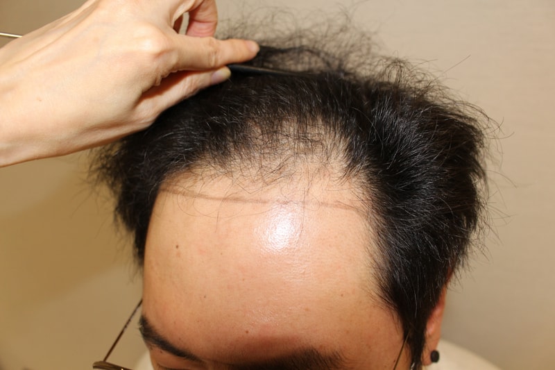 수술후 6개월 경과 후기입니다
