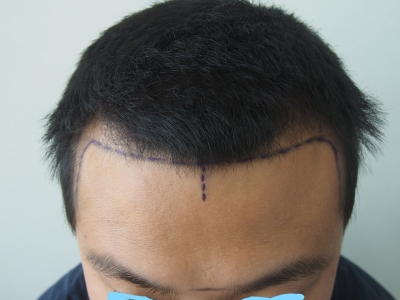 May 18th, 1016 hair follicles