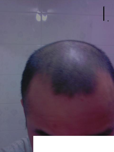 수술전 1.JPG