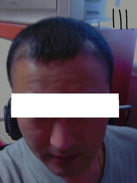 수술후1달째.JPG