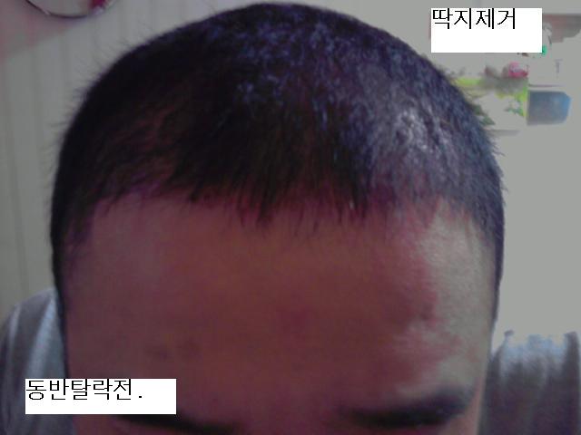 딱지제거173.jpg