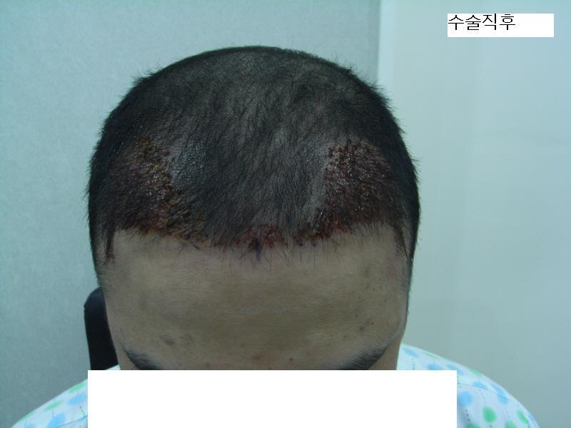 수술직후.JPG