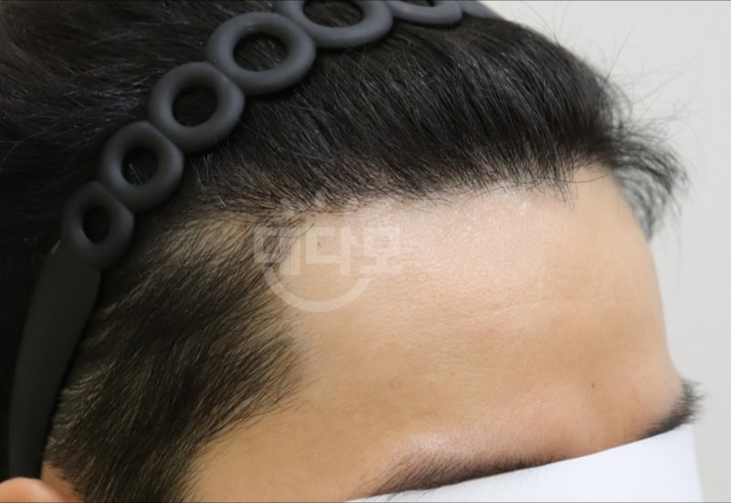 First year of transplantation. How many hair should I reinforce
