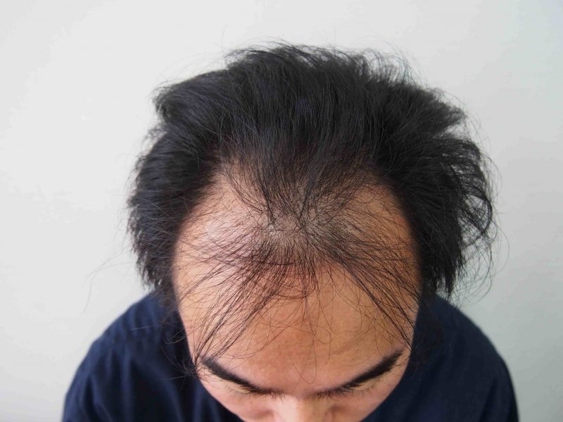 비절개 2360모낭 1년차 병원다녀왔습니다^^..