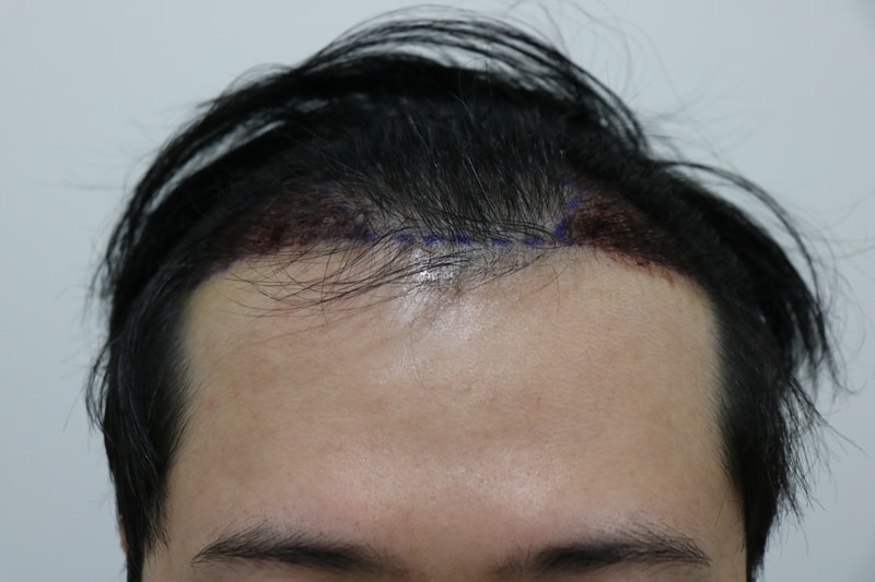 수술 후 앞1.jpg