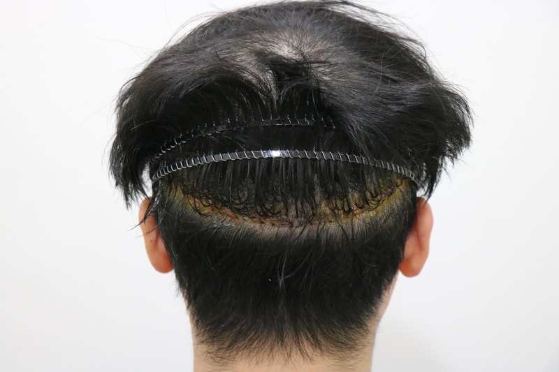 수술 후 뒷머리.jpg