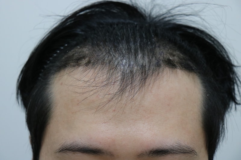 수술 2주후 앞.jpg