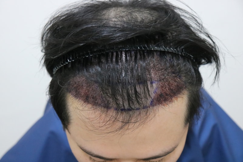 수술 후 위.jpg