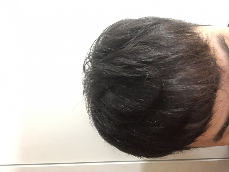 수술후 1140일 경과.