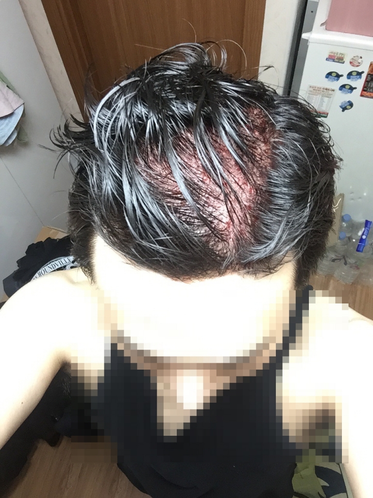수술직후.jpg