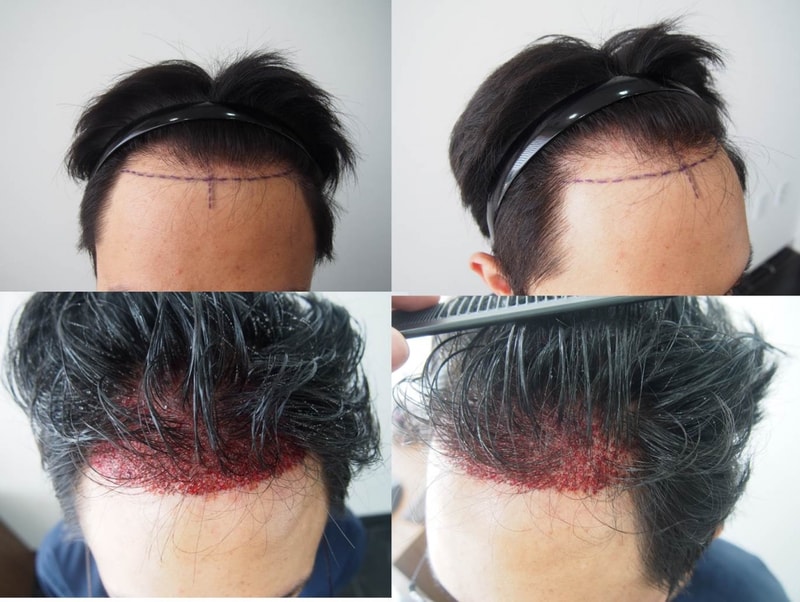 비절개 1100모낭 입니다