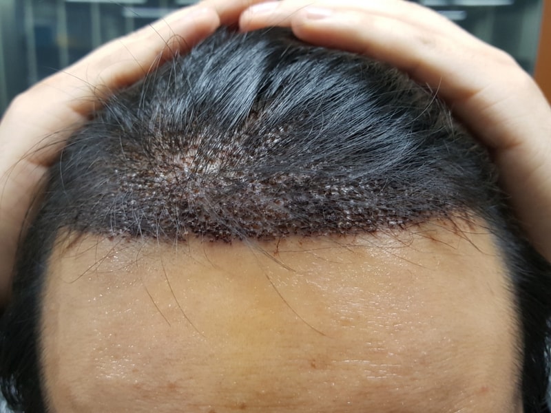 10일차 딱지제거하였습니다.