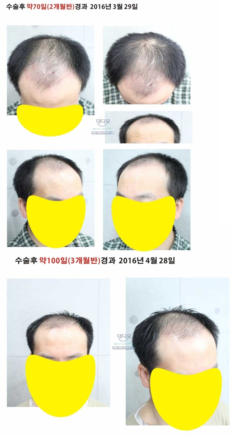 절개 비절개 혼합 5120모 수술후 약 100일경과