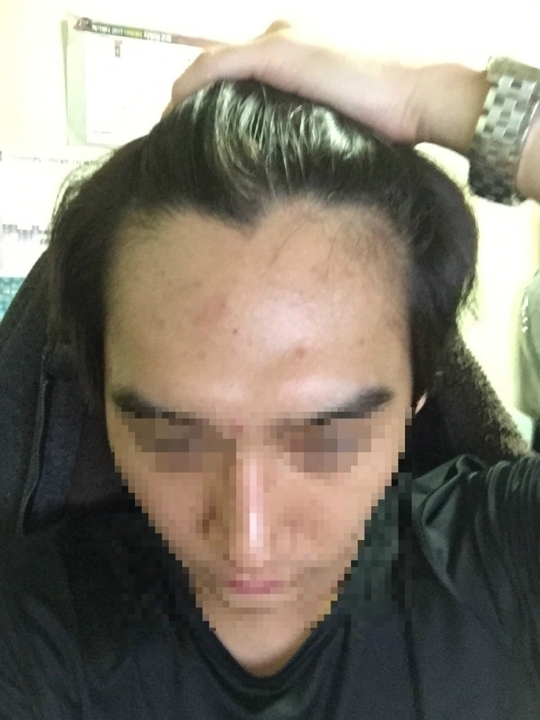 18일차 JP 비절개 슬릿 1500모 사진 봐주시면 감사하겠습니다