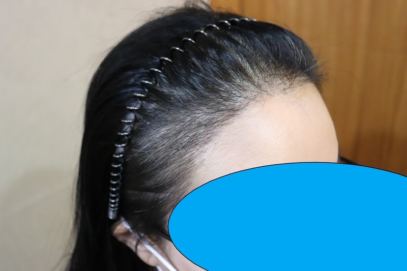 수술 2주 후 6.jpg