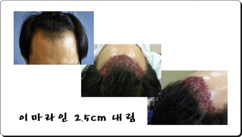 이마2-.jpg