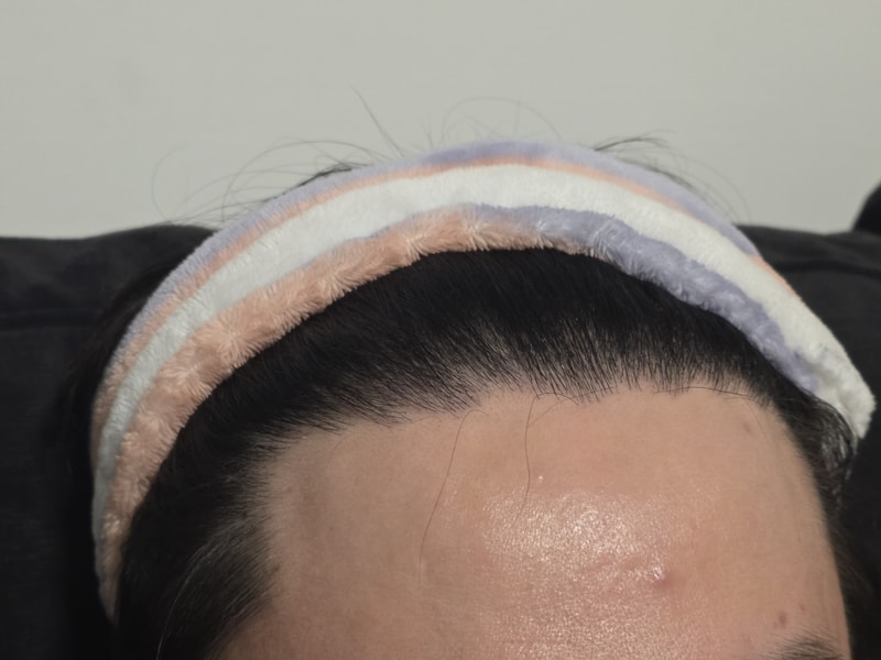 ★モプロ医院★ ヘアライン植毛、切開 3900本、6ヵ月経過