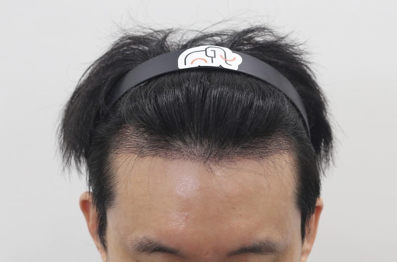 수술_2주차_03_수술후_240323.jpg