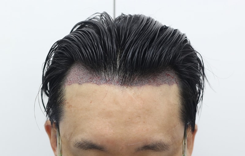수술_03_후_240307.jpg