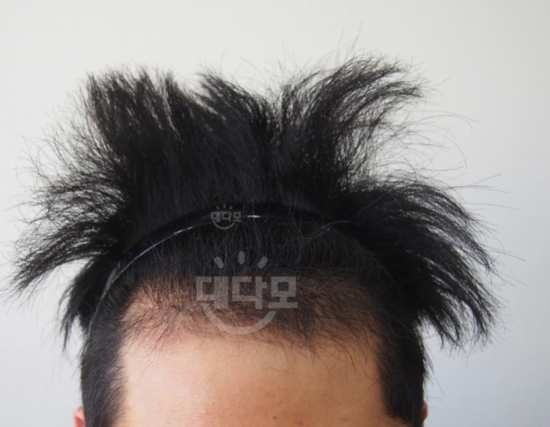 This is the first year of parent hair transplantation.