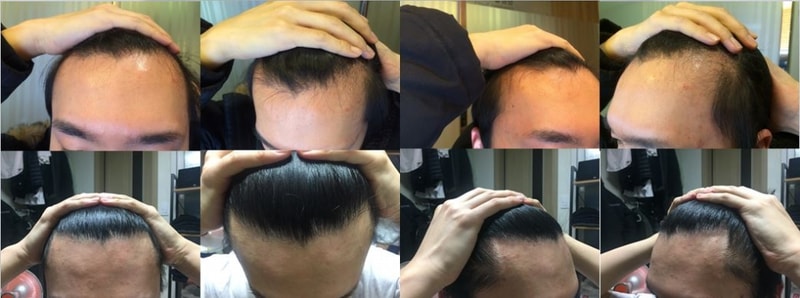 뉴헤어 1400모낭 1년 총평 후기입니다.
