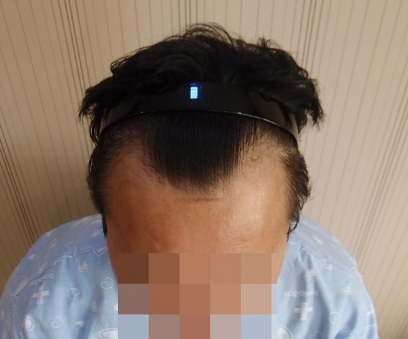 수술전 위쪽.JPG