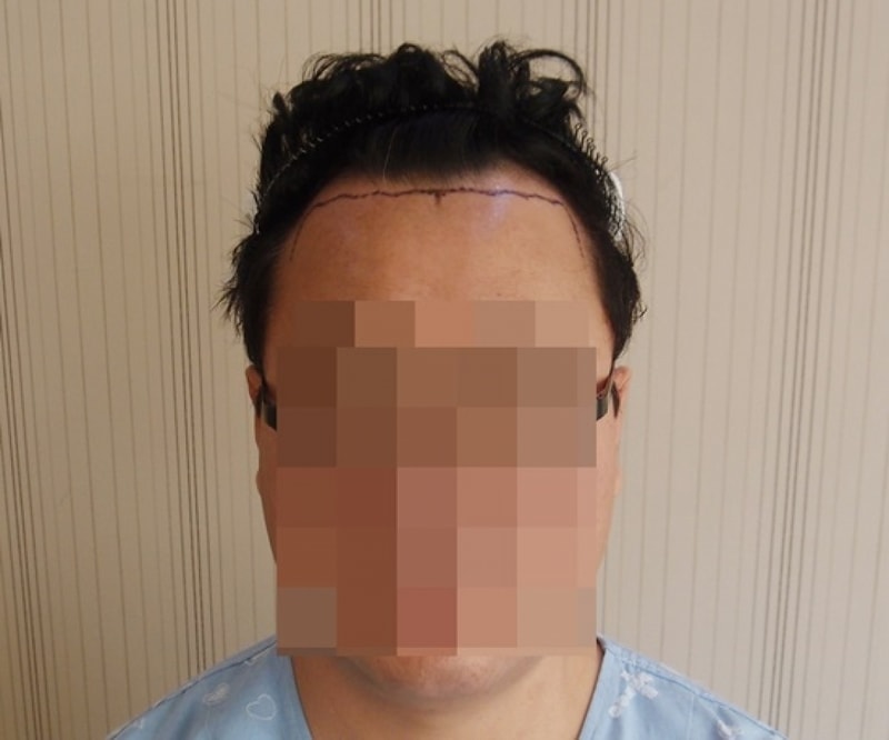 수술전 정면.JPG