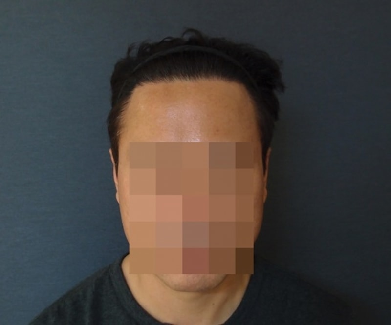 수술후 정면.JPG