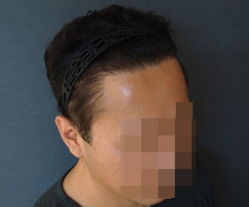 수술후 오른쪽.JPG