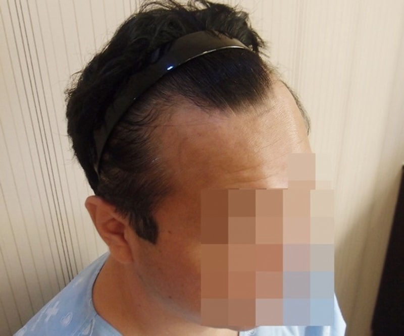 수술전 오른쪽.JPG