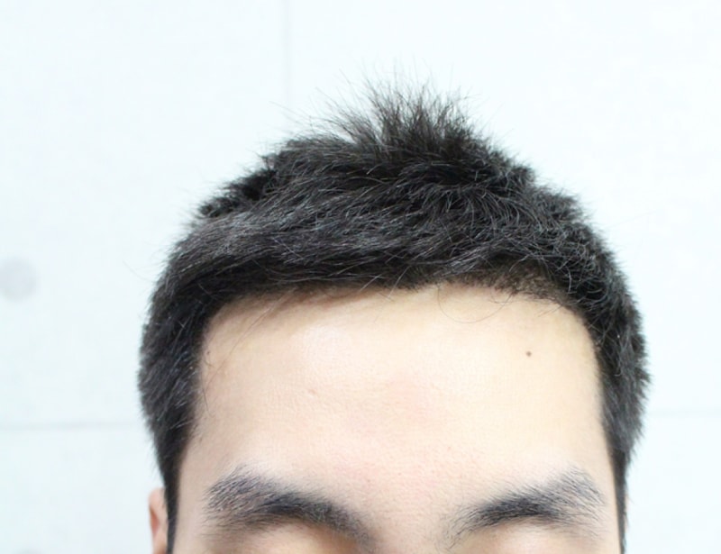 수술후이거.png