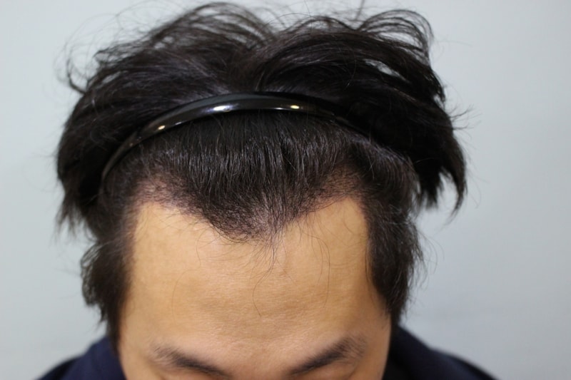 수술후 13일 (1).JPG
