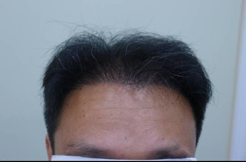 6th Month of Transplantation