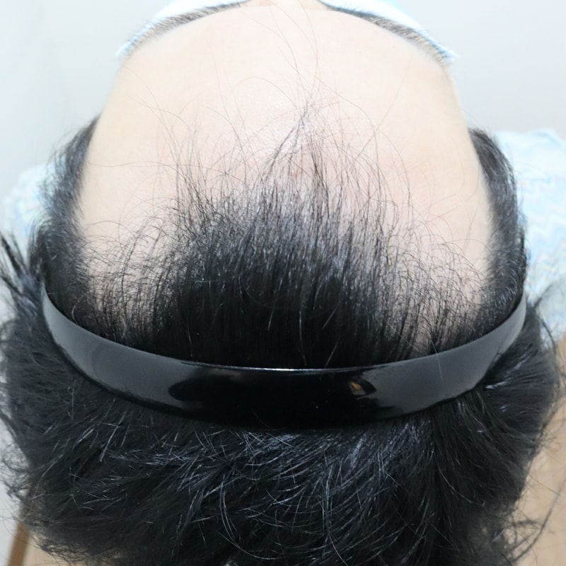 비절개 모발이식 3600모 후기입니다.