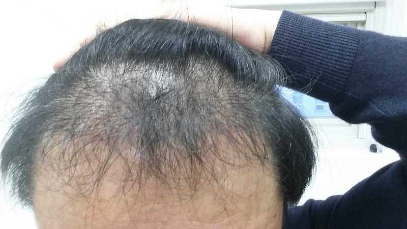 수술후 정확히 6개월 되었습니다.  ^&^