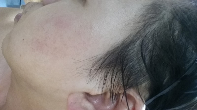 남자 헤어라인 (구레나룻+측면)4개월