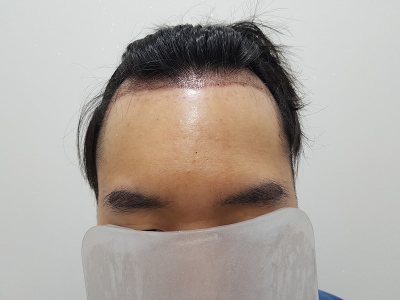 비절개 M자+구레나룻+눈썹 수술 다음날