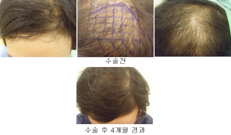 수술경과사진.JPG