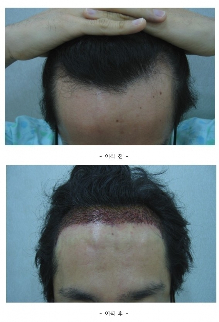이식 전후.jpg