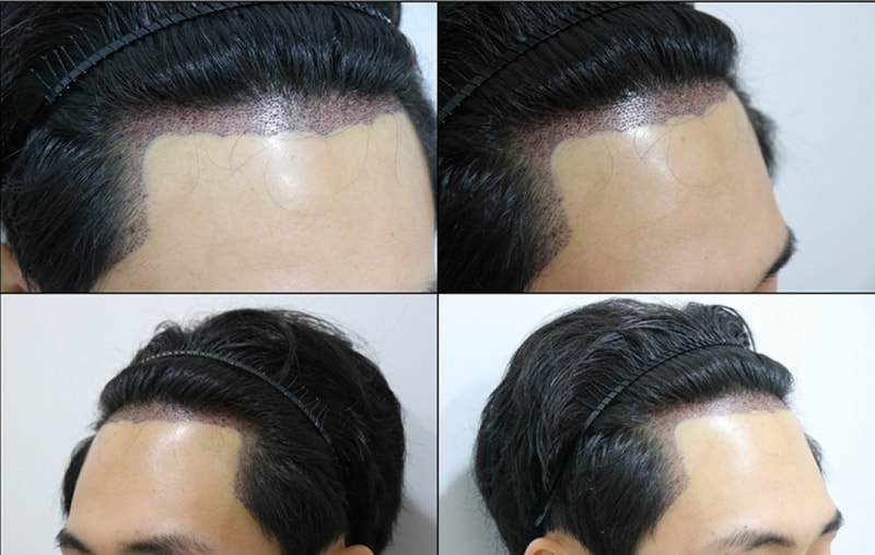 수술 후1.jpg