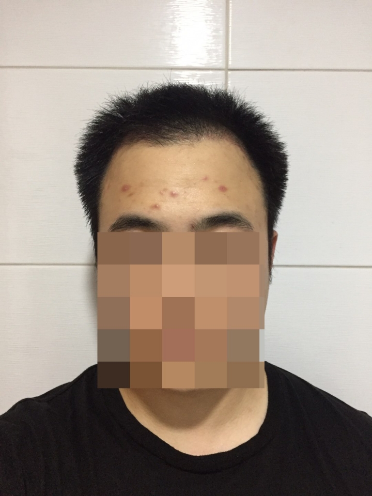 엠자 수술후 이제 3개월에 접어들어요