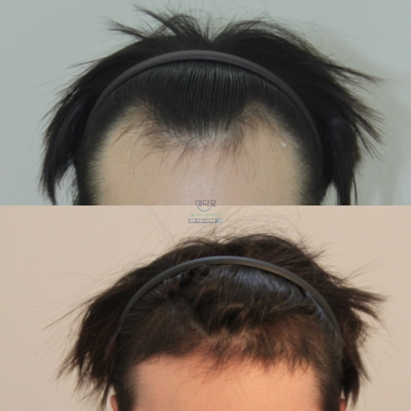 포헤어 1500모낭 수술전 / 4 / 6 / 9 / 12 개월차