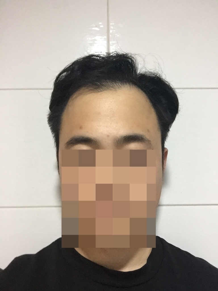 엠자 수술 받고 첫 리뷰 올려봅니다