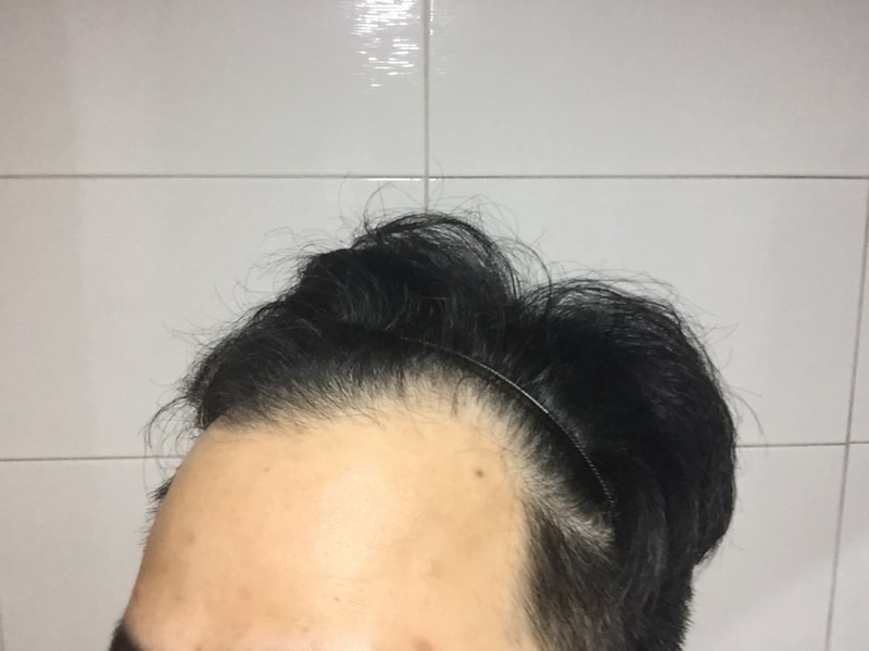 수술전왼쪽.jpg